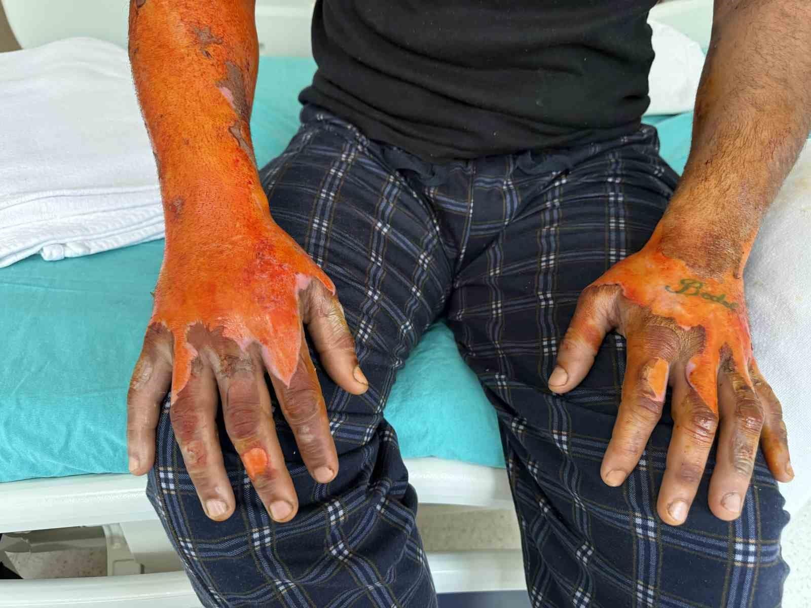 Akü patlaması, vücudunun yüzde 25’i yandı: "Bomba gibi patlamalar, kendimi zor kurtardım"